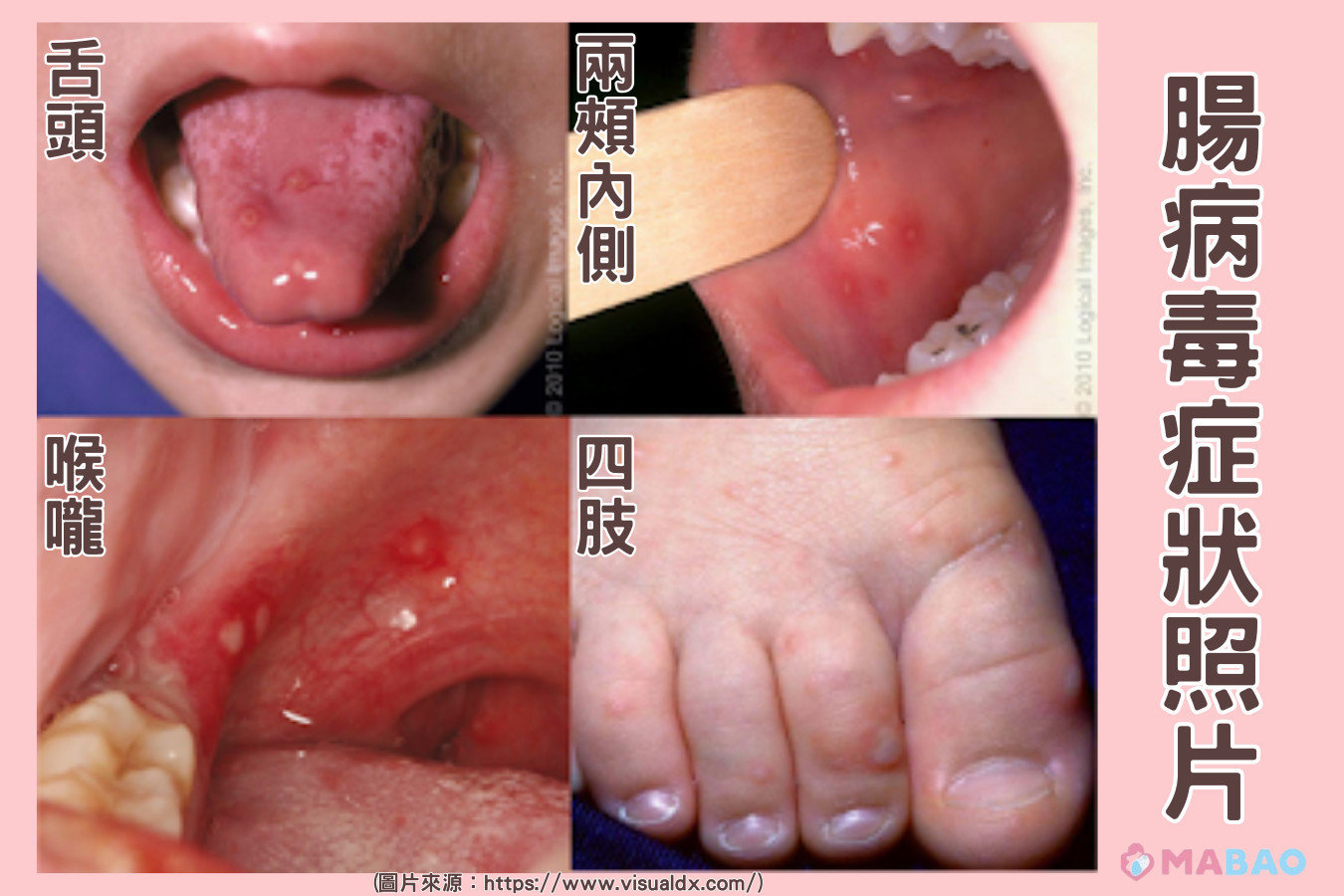 腸病毒照片