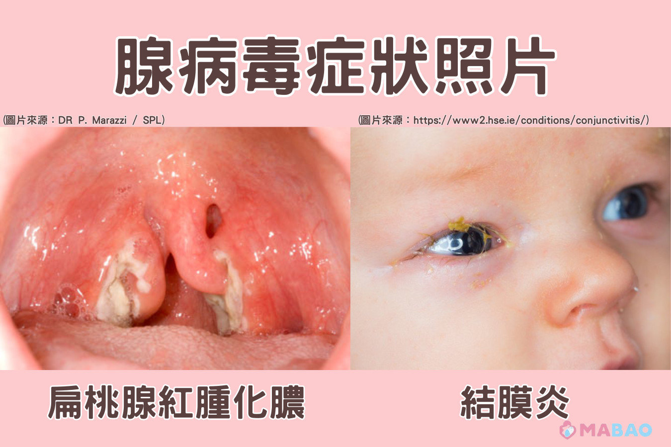 腺病毒症狀照片