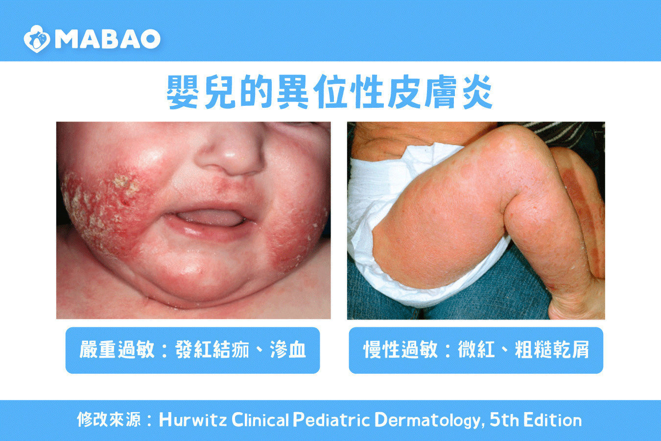 嬰兒起疹子怎麼辦-異位性皮膚炎