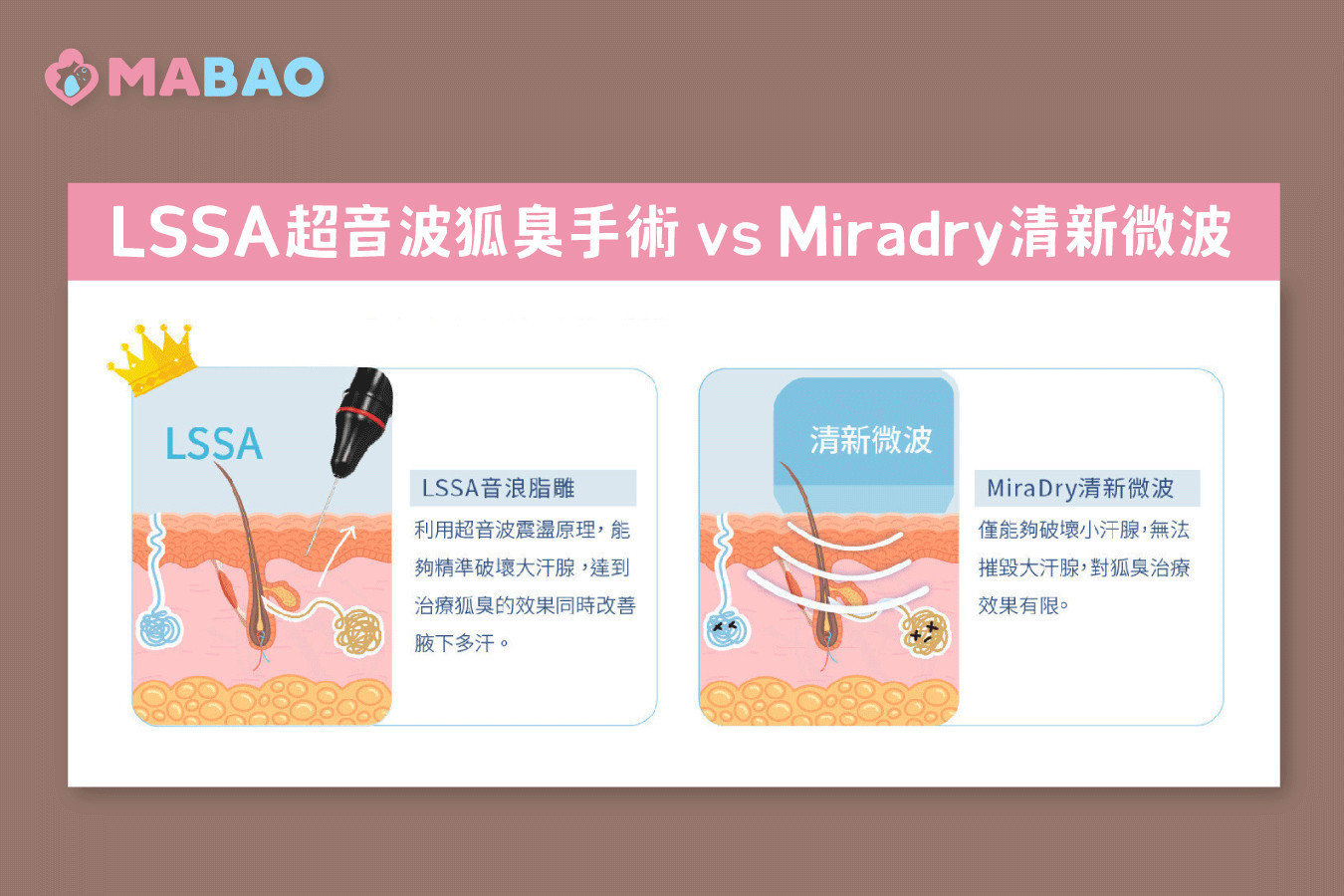 狐臭手術和Miradry清新微波的差別-狐臭手術有哪些