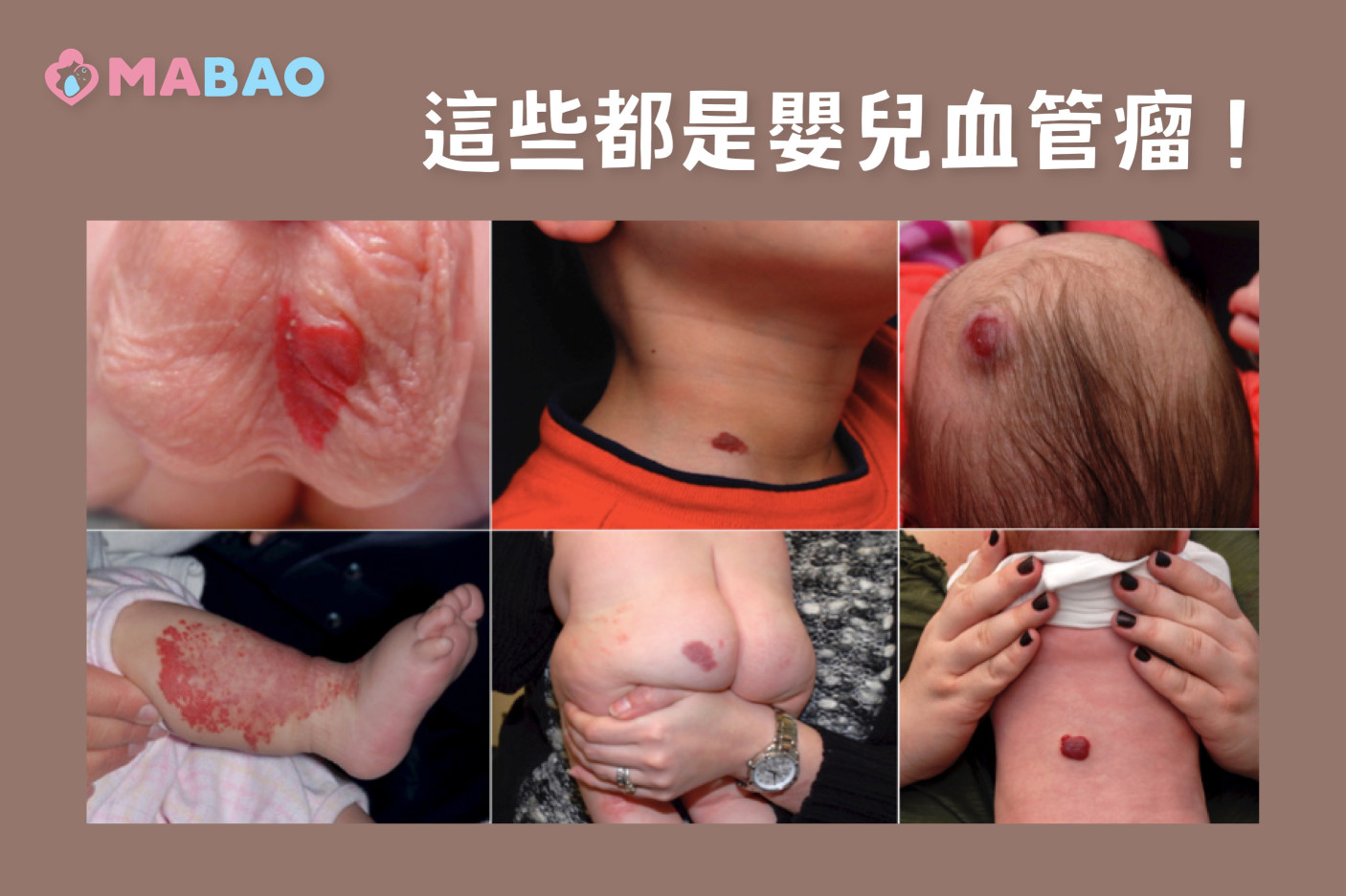 嬰兒血管瘤-嬰兒皮膚出現紅點腫塊