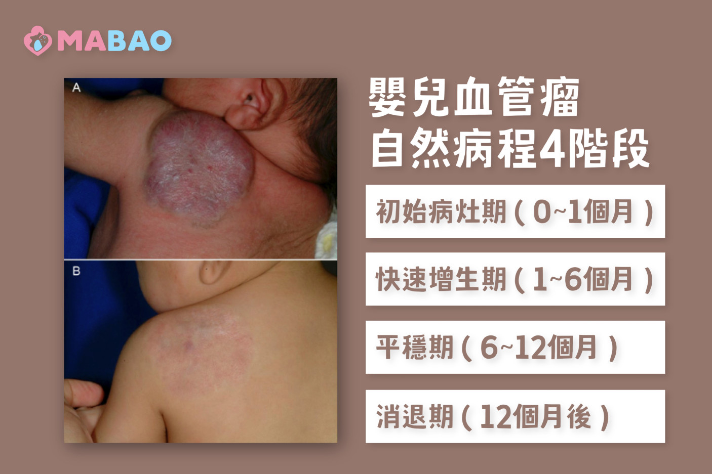 嬰兒血管瘤會消失嗎-自然病程4階段