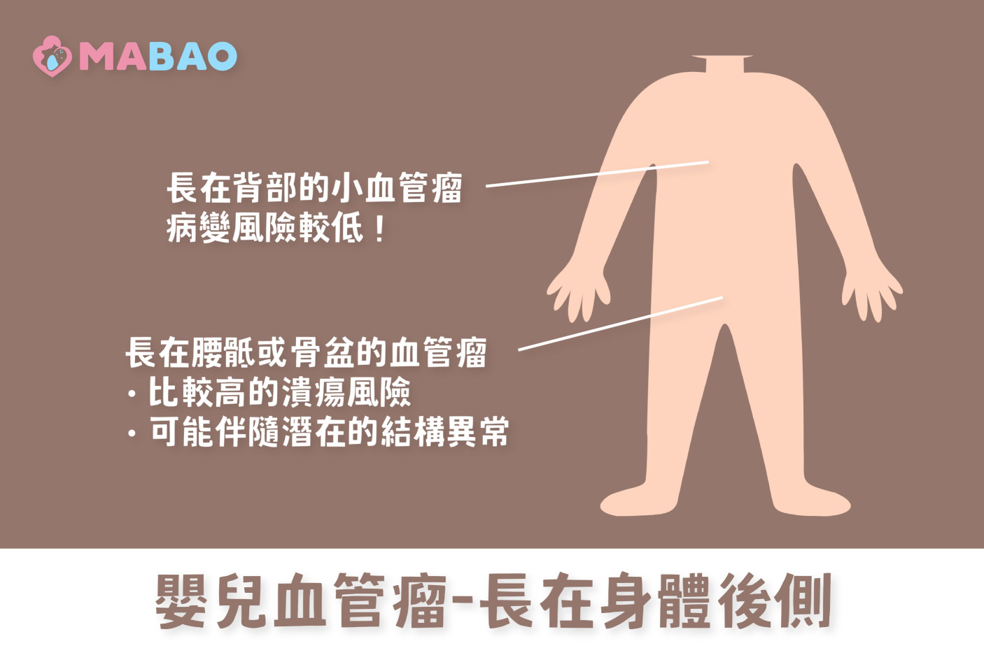 嬰兒血管瘤治療-長在身體後側