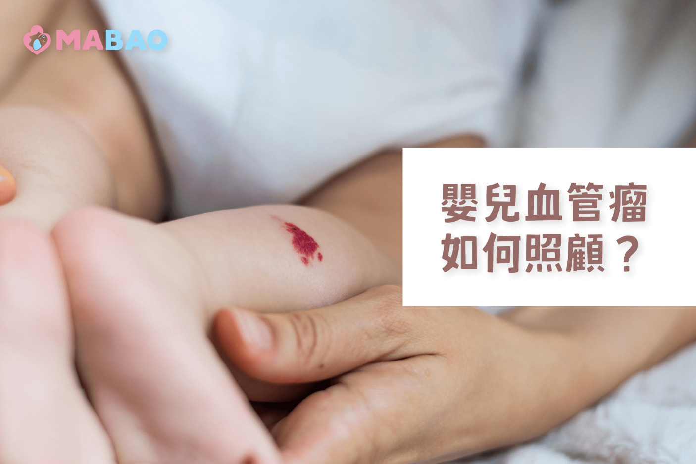 嬰兒血管瘤如何照顧-常見QA